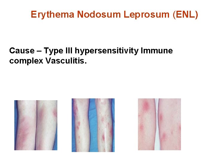 Erythema Nodosum Leprosum (ENL) Cause – Type III hypersensitivity Immune complex Vasculitis. 