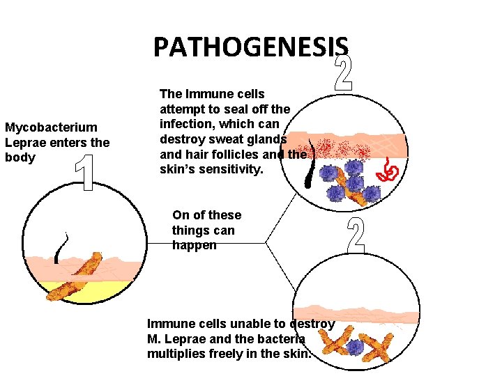 PATHOGENESIS Mycobacterium Leprae enters the body The Immune cells attempt to seal off the