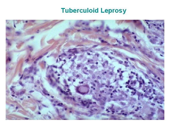 Tuberculoid Leprosy 