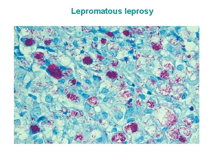 Lepromatous leprosy 