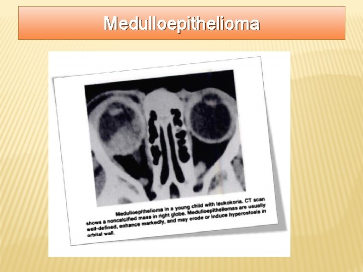 Medulloepithelioma 