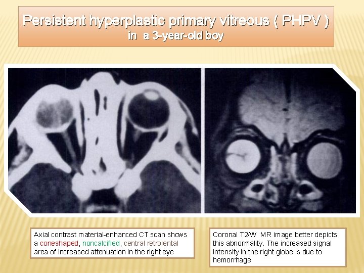 Persistent hyperplastic primary vitreous ( PHPV ) in a 3 -year-old boy Axial contrast