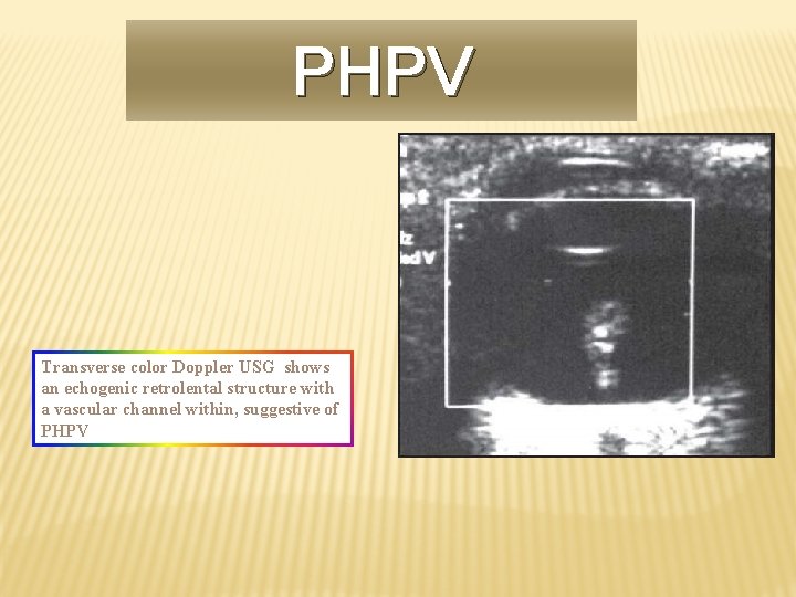 PHPV Transverse color Doppler USG shows an echogenic retrolental structure with a vascular channel