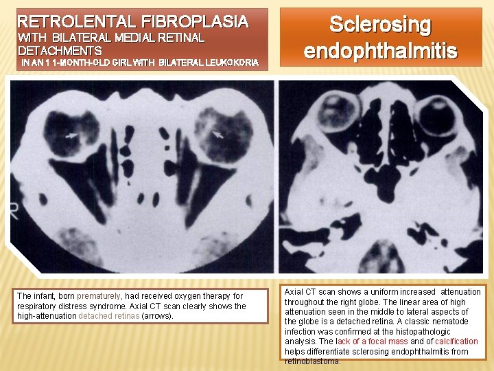RETROLENTAL FIBROPLASIA WITH BILATERAL MEDIAL RETINAL DETACHMENTS IN AN 1 1 -MONTH-OLD GIRL WITH