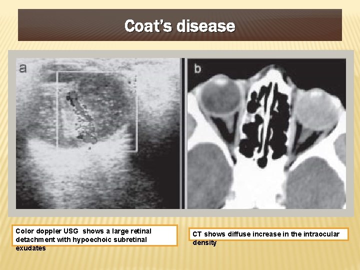Coat’s disease Color doppler USG shows a large retinal detachment with hypoechoic subretinal exudates