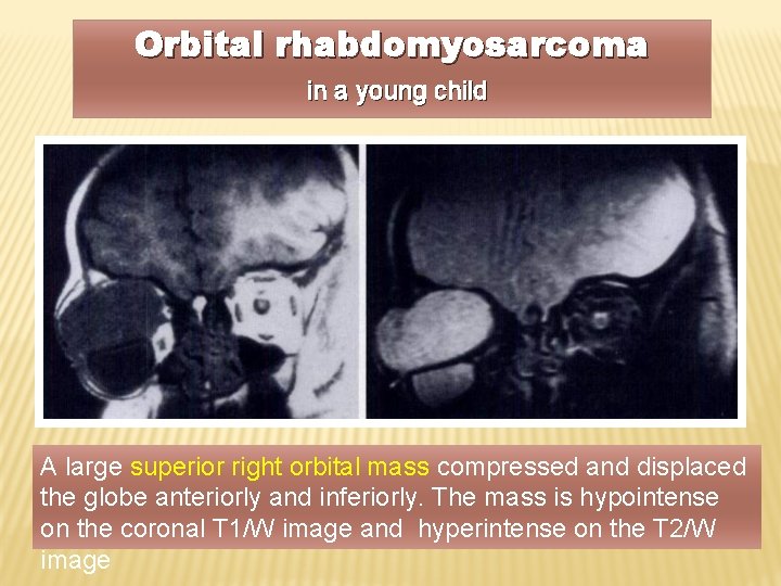 Orbital rhabdomyosarcoma in a young child A large superior right orbital mass compressed and