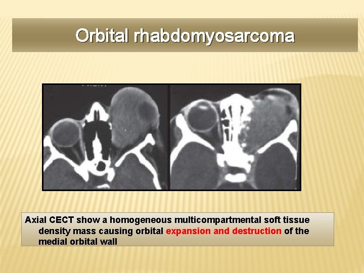 Orbital rhabdomyosarcoma Axial CECT show a homogeneous multicompartmental soft tissue density mass causing orbital