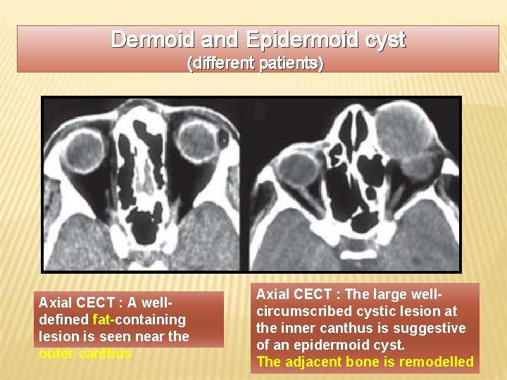 Dermoid and Epidermoid cyst (different patients) Axial CECT : A welldefined fat-containing lesion is
