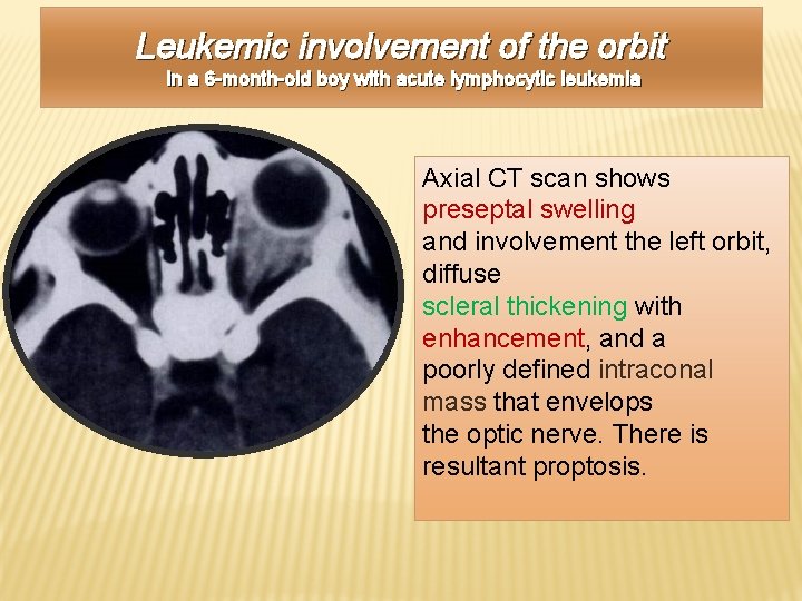 Leukemic involvement of the orbit in a 6 -month-old boy with acute lymphocytic leukemia