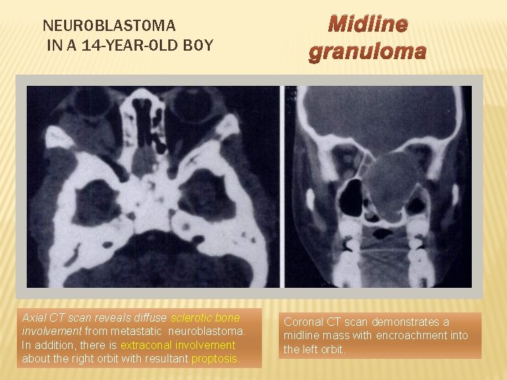 NEUROBLASTOMA IN A 14 -YEAR-OLD BOY Axial CT scan reveals diffuse sclerotic bone involvement