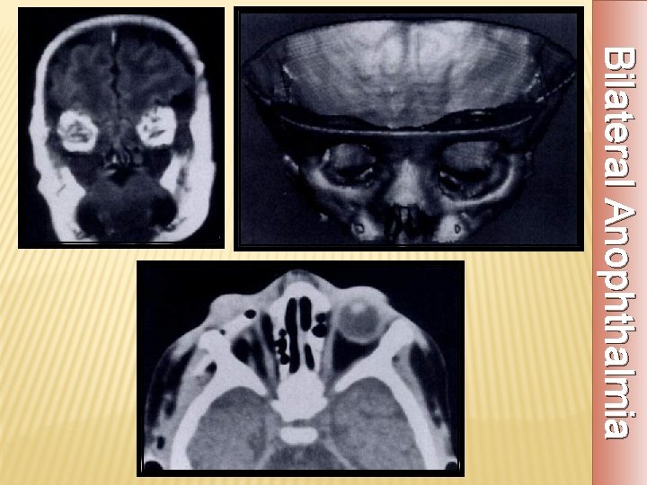 Bilateral Anophthalmia 