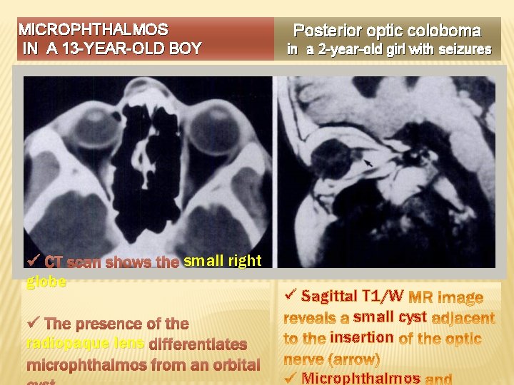 MICROPHTHALMOS IN A 13 -YEAR-OLD BOY ü CT scan shows the small right globe