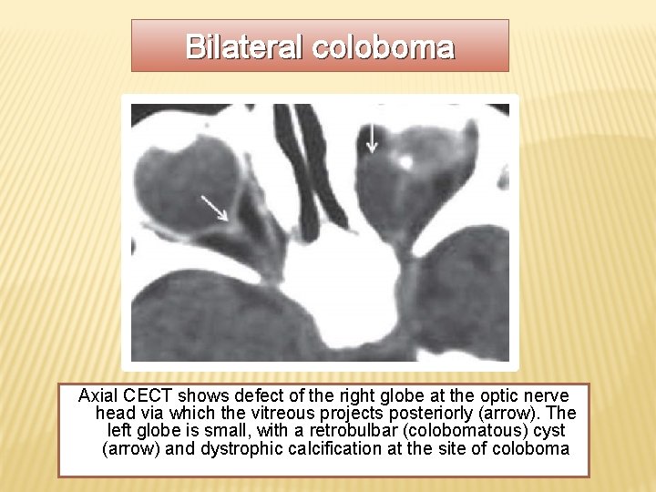 Bilateral coloboma Axial CECT shows defect of the right globe at the optic nerve