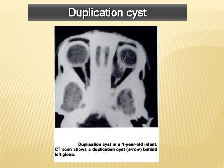 Duplication cyst 