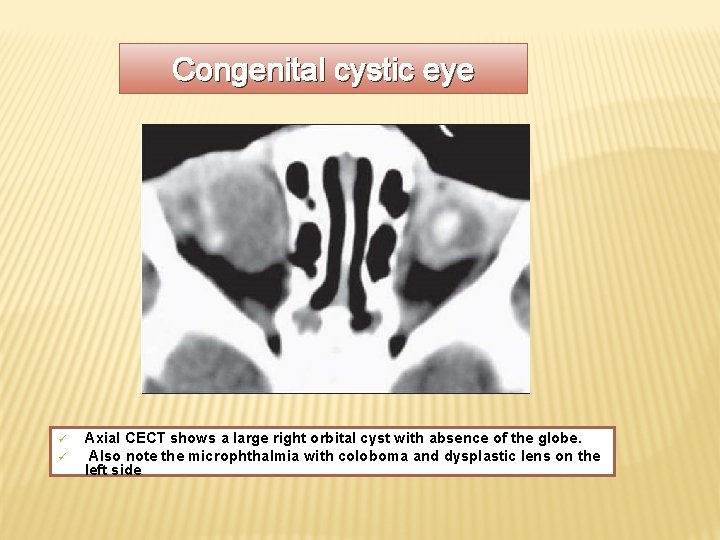 Congenital cystic eye ü ü Axial CECT shows a large right orbital cyst with