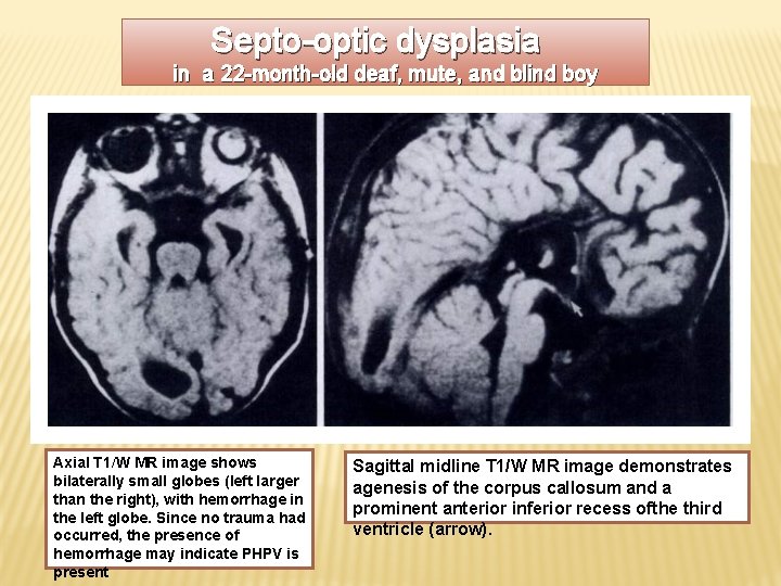 Septo-optic dysplasia in a 22 -month-old deaf, mute, and blind boy Axial T 1/W
