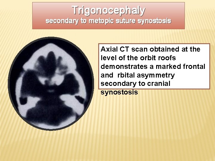 Trigonocephaly secondary to metopic suture synostosis Axial CT scan obtained at the level of