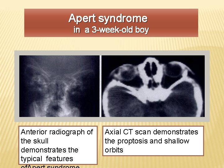 Apert syndrome in a 3 -week-old boy Anterior radiograph of the skull demonstrates the