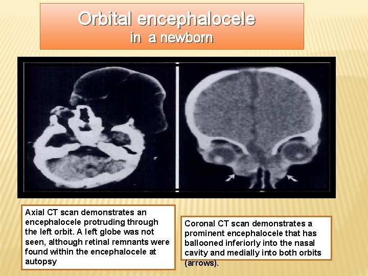 Orbital encephalocele in a newborn Axial CT scan demonstrates an encephalocele protruding through the