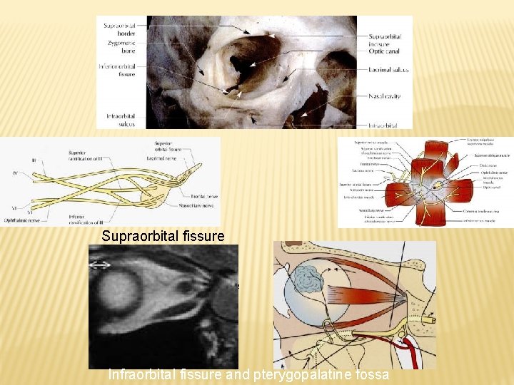 Supraorbital fissure Infraorbital fissure and pterygopalatine fossa 