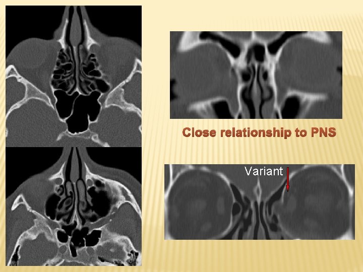 Close relationship to PNS Variant 