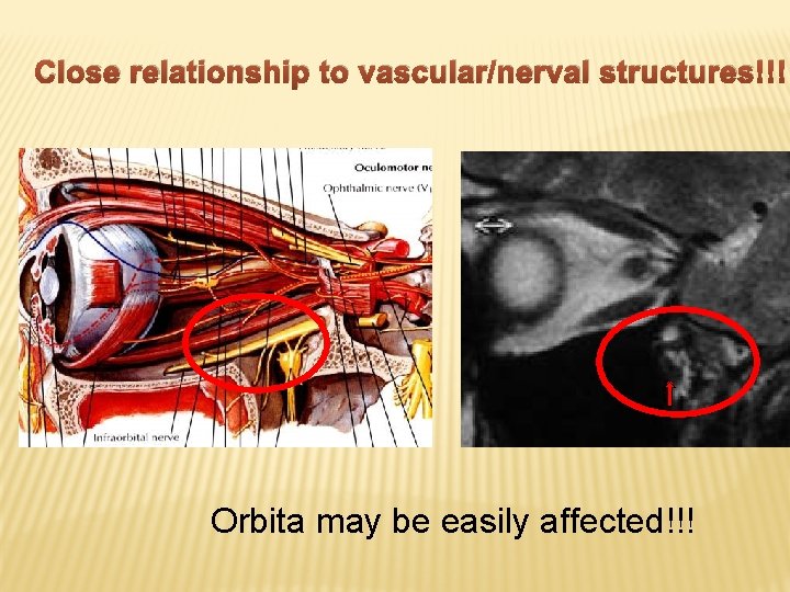 Close relationship to vascular/nerval structures!!! Orbita may be easily affected!!! 
