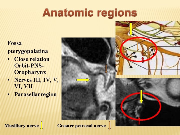 Anatomic regions Fossa pterygopalatina • Close relation Orbit-PNSOropharynx • Nerves III, IV, V, VII