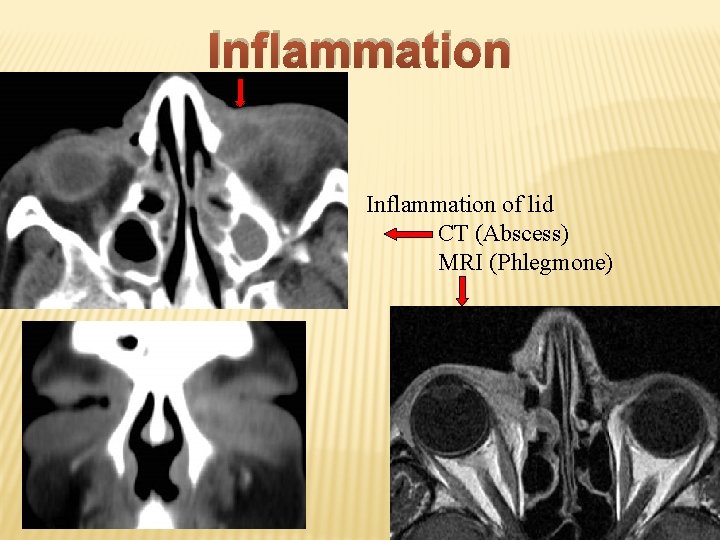 Inflammation of lid CT (Abscess) MRI (Phlegmone) 