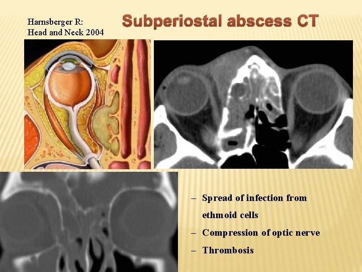 Harnsberger R: Head and Neck 2004 Subperiostal abscess CT – Spread of infection from