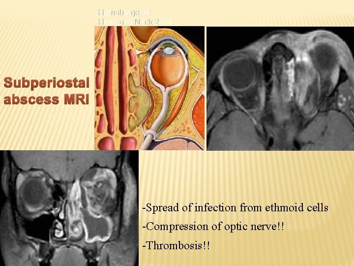 Harnsberger R: Head and Neck 2004 Subperiostal abscess MRI -Spread of infection from ethmoid
