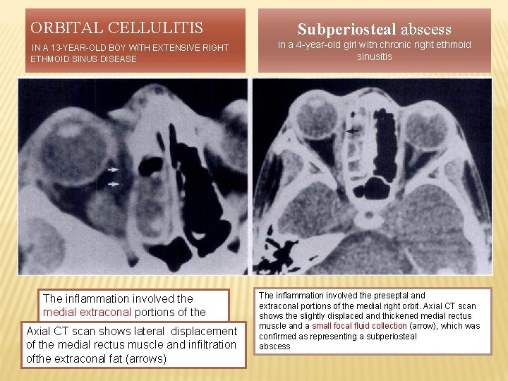 ORBITAL CELLULITIS IN A 13 -YEAR-OLD BOY WITH EXTENSIVE RIGHT ETHMOID SINUS DISEASE The