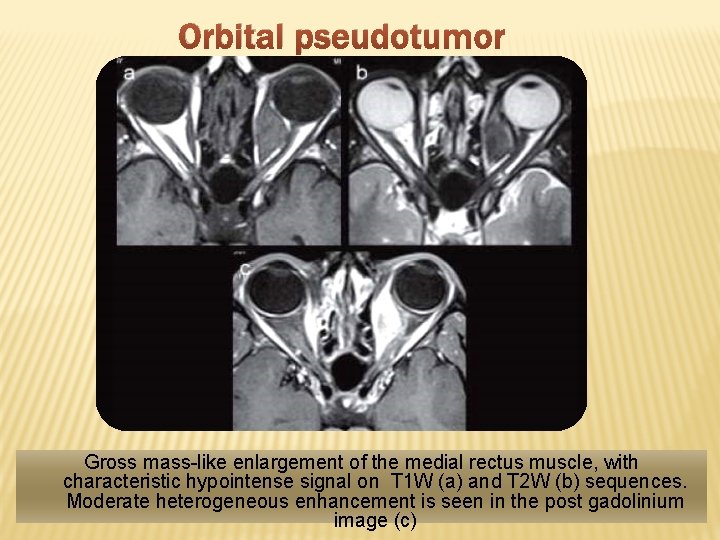 Orbital pseudotumor Gross mass-like enlargement of the medial rectus muscle, with characteristic hypointense signal