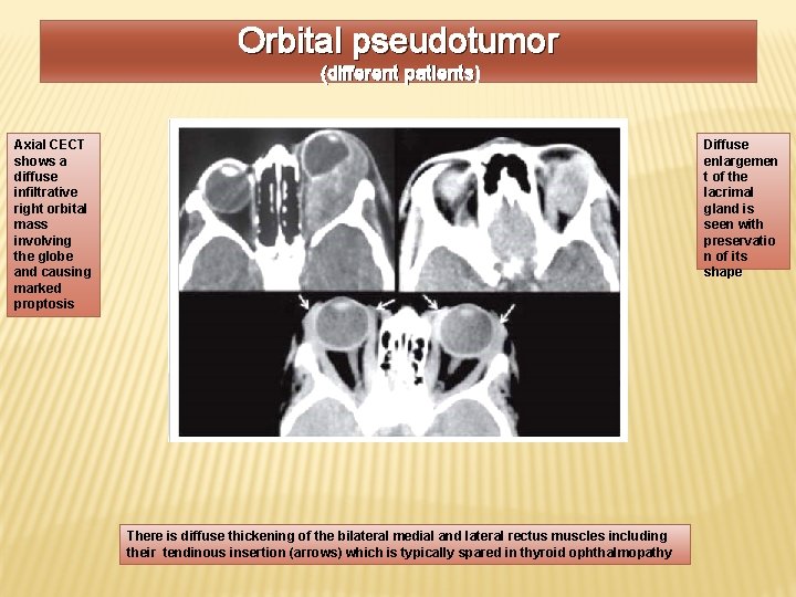 Orbital pseudotumor (different patients) Diffuse enlargemen t of the lacrimal gland is seen with