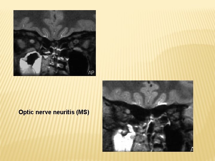 Optic nerve neuritis (MS) 