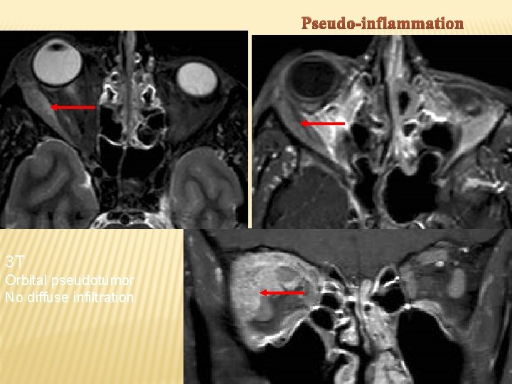 Pseudo-inflammation 3 T Orbital pseudotumor No diffuse infiltration 