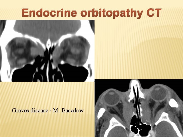 Endocrine orbitopathy CT Graves disease / M. Basedow 