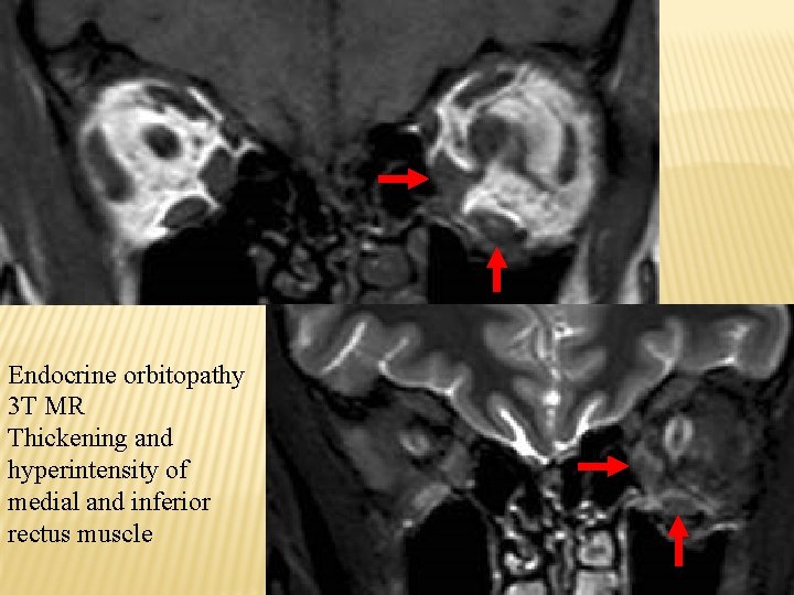 Endocrine orbitopathy 3 T MR Thickening and hyperintensity of medial and inferior rectus muscle