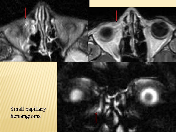 Small capillary hemangioma 