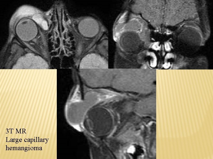 3 T MR Large capillary hemangioma 