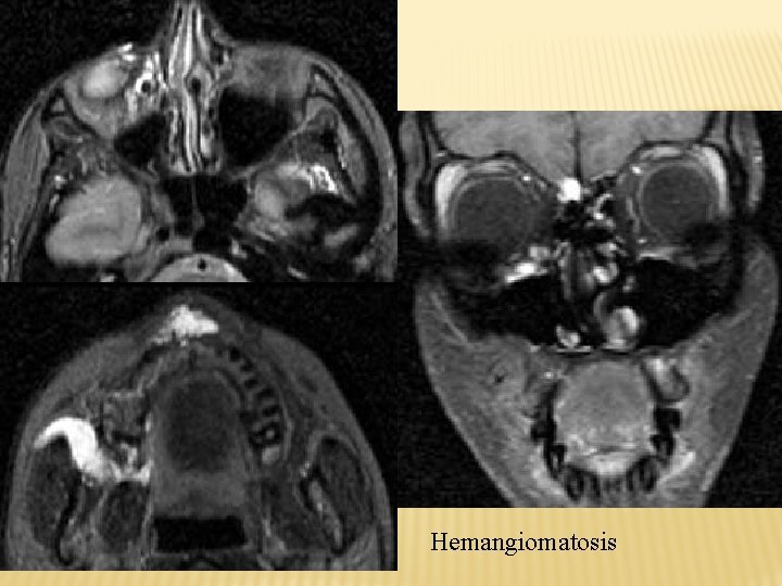 Hemangiomatosis 