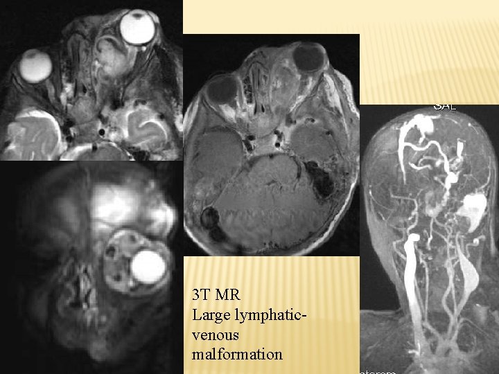 3 T MR Large lymphaticvenous malformation 