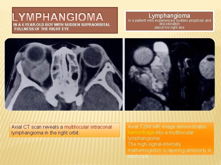 LYMPHANGIOMA IN A 4 -YEAR-OLD BOY WITH SUDDEN SUPRAORBITAL FULLNESS OF THE RIGHT EYE