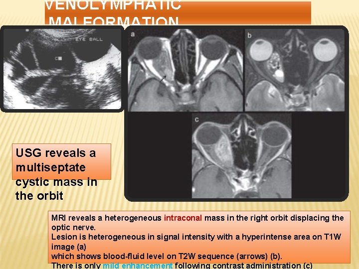 VENOLYMPHATIC MALFORMATION USG reveals a multiseptate cystic mass in the orbit MRI reveals a