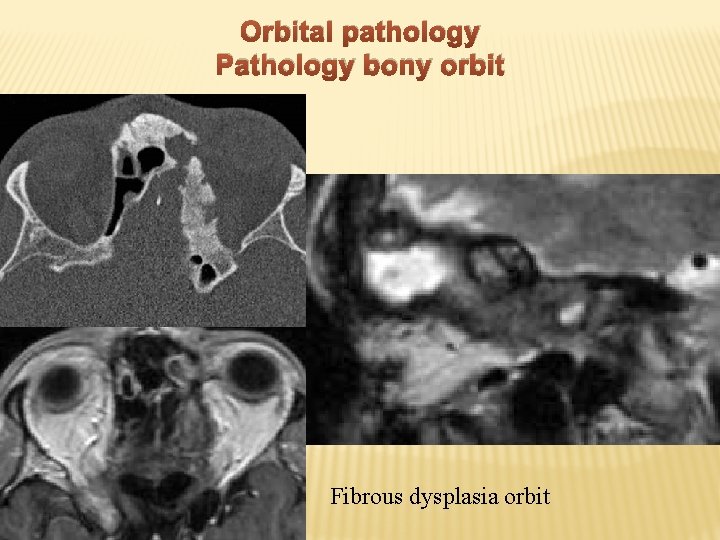Orbital pathology Pathology bony orbit Fibrous dysplasia orbit 