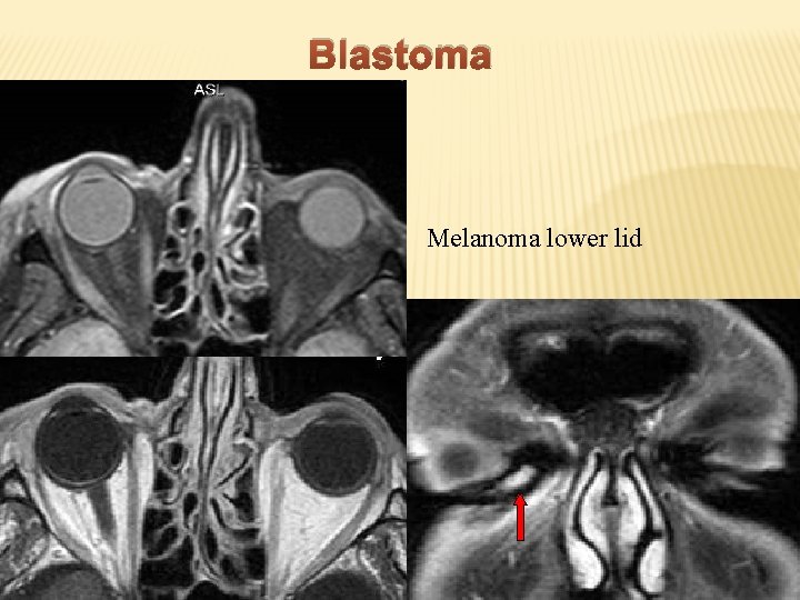 Blastoma Melanoma lower lid 
