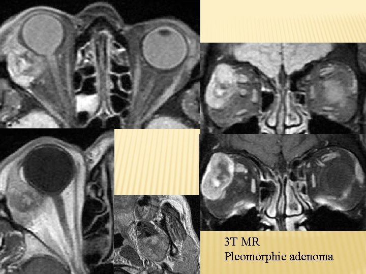 3 T MR Pleomorphic adenoma 