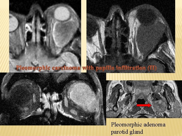 Pleomorphic carcinoma with papilla infiltration (II) Pleomorphic adenoma parotid gland 