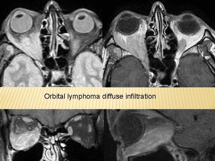 Orbital lymphoma diffuse infiltration 