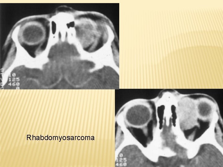 Rhabdomyosarcoma 