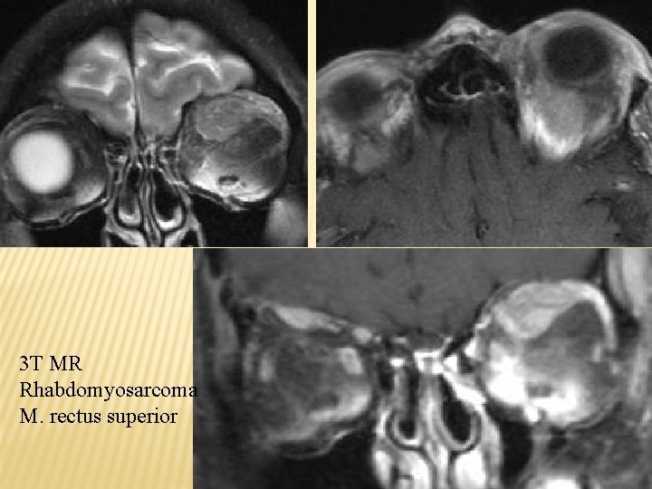 3 T MR Rhabdomyosarcoma M. rectus superior 